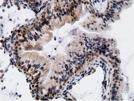 EPM2AIP1 Antibody - IHC of paraffin-embedded Carcinoma of Human lung tissue using anti-EPM2AIP1 mouse monoclonal antibody.