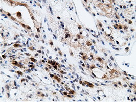 EPM2AIP1 Antibody - IHC of paraffin-embedded Carcinoma of Human kidney tissue using anti-EPM2AIP1 mouse monoclonal antibody.