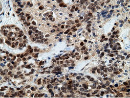 EPM2AIP1 Antibody - IHC of paraffin-embedded Adenocarcinoma of Human ovary tissue using anti-EPM2AIP1 mouse monoclonal antibody.