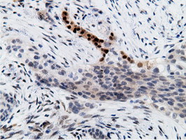 EPM2AIP1 Antibody - IHC of paraffin-embedded Carcinoma of Human pancreas tissue using anti-EPM2AIP1 mouse monoclonal antibody.