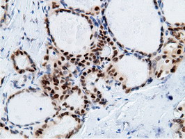 EPM2AIP1 Antibody - IHC of paraffin-embedded Carcinoma of Human thyroid tissue using anti-EPM2AIP1 mouse monoclonal antibody.