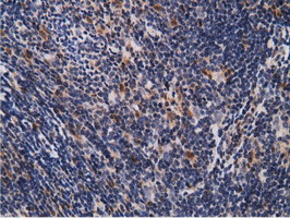 EPM2AIP1 Antibody - IHC of paraffin-embedded Human lymphoma tissue using anti-EPM2AIP1 mouse monoclonal antibody.