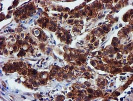 EPN2 Antibody - IHC of paraffin-embedded Carcinoma of Human lung tissue using anti-EPN2 mouse monoclonal antibody.