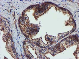 EPN2 Antibody - IHC of paraffin-embedded Carcinoma of Human prostate tissue using anti-EPN2 mouse monoclonal antibody.