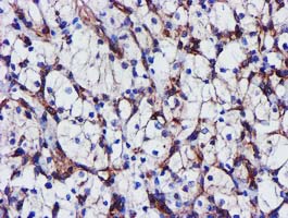 EPN2 Antibody - IHC of paraffin-embedded Carcinoma of Human kidney tissue using anti-EPN2 mouse monoclonal antibody.