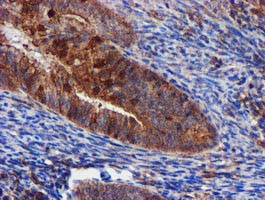 EPN2 Antibody - IHC of paraffin-embedded Adenocarcinoma of Human endometrium tissue using anti-EPN2 mouse monoclonal antibody.