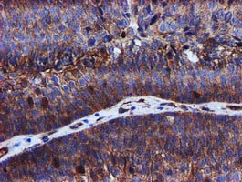 EPN2 Antibody - IHC of paraffin-embedded Carcinoma of Human bladder tissue using anti-EPN2 mouse monoclonal antibody.