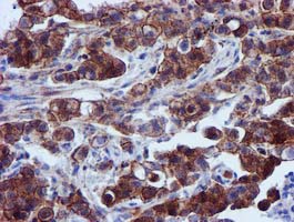 EPN2 Antibody - IHC of paraffin-embedded Carcinoma of Human lung tissue using anti-EPN2 mouse monoclonal antibody. (Heat-induced epitope retrieval by 10mM citric buffer, pH6.0, 100C for 10min).