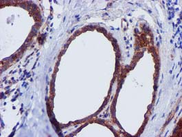 EPN2 Antibody - IHC of paraffin-embedded Human breast tissue using anti-EPN2 mouse monoclonal antibody. (Heat-induced epitope retrieval by 10mM citric buffer, pH6.0, 100C for 10min).