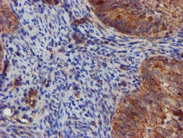 EPN2 Antibody - IHC of paraffin-embedded Adenocarcinoma of Human endometrium tissue using anti-EPN2 mouse monoclonal antibody. (Heat-induced epitope retrieval by 10mM citric buffer, pH6.0, 100C for 10min).