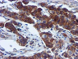EPN2 Antibody - IHC of paraffin-embedded Carcinoma of Human lung tissue using anti-EPN2 mouse monoclonal antibody.