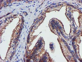 EPN2 Antibody - IHC of paraffin-embedded Carcinoma of Human prostate tissue using anti-EPN2 mouse monoclonal antibody.