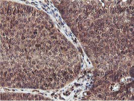 EPN2 Antibody - IHC of paraffin-embedded Carcinoma of Human bladder tissue using anti-EPN2 mouse monoclonal antibody.