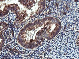 EPN2 Antibody - IHC of paraffin-embedded Adenocarcinoma of Human endometrium tissue using anti-EPN2 mouse monoclonal antibody. (Heat-induced epitope retrieval by 10mM citric buffer, pH6.0, 100C for 10min).
