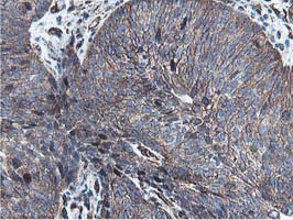 EPN2 Antibody - IHC of paraffin-embedded Carcinoma of Human bladder tissue using anti-EPN2 mouse monoclonal antibody. (Heat-induced epitope retrieval by 10mM citric buffer, pH6.0, 100C for 10min).