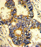 EPN3 Antibody - Formalin-fixed and paraffin-embedded human colon carcinoma with EPN3 Antibody , which was peroxidase-conjugated to the secondary antibody, followed by DAB staining. This data demonstrates the use of this antibody for immunohistochemistry; clinical relevance has not been evaluated.