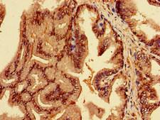 EPN3 Antibody - Immunohistochemistry image of paraffin-embedded human prostate cancer at a dilution of 1:100