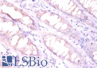 EPO / Erythropoietin Antibody - Immunohistochemistry of paraffin-embedded human colorectal carcinoma using Erythropoietin / EPO antibody at dilution of 1:100.  This image was taken for the unconjugated form of this product. Other forms have not been tested.