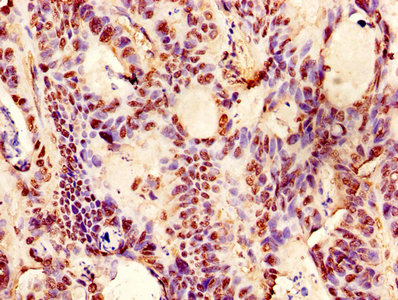 EPO / Erythropoietin Antibody - Immunohistochemistry of paraffin-embedded human colon cancer using EPO Antibody at dilution of 1:100