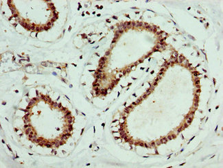 EPOR / EPO Receptor Antibody - Immunohistochemistry image at a dilution of 1:400 and staining in paraffin-embedded human breast cancer performed on a Leica BondTM system. After dewaxing and hydration, antigen retrieval was mediated by high pressure in a citrate buffer (pH 6.0) . Section was blocked with 10% normal goat serum 30min at RT. Then primary antibody (1% BSA) was incubated at 4 °C overnight. The primary is detected by a biotinylated secondary antibody and visualized using an HRP conjugated SP system.
