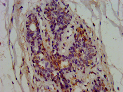 EPRS / PARS Antibody - Immunohistochemistry image at a dilution of 1:600 and staining in paraffin-embedded human breast cancer performed on a Leica BondTM system. After dewaxing and hydration, antigen retrieval was mediated by high pressure in a citrate buffer (pH 6.0) . Section was blocked with 10% normal goat serum 30min at RT. Then primary antibody (1% BSA) was incubated at 4 °C overnight. The primary is detected by a biotinylated secondary antibody and visualized using an HRP conjugated SP system.