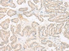 EPRS / PARS Antibody - Immunohistochemistry of paraffin-embedded Human thyroid cancer tissue  using EPRS Polyclonal Antibody at dilution of 1:60(×200)