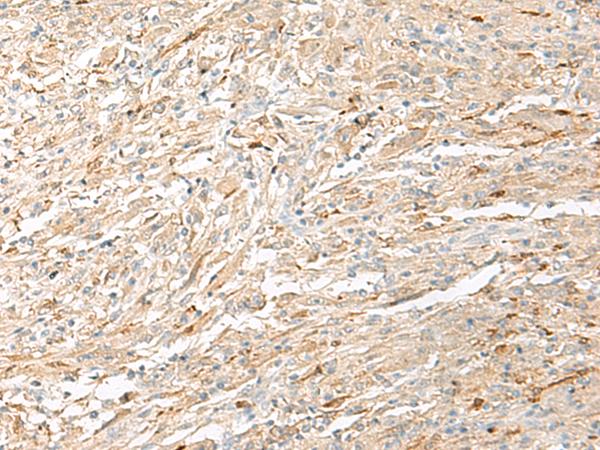 EPRS / PARS Antibody - Immunohistochemistry of paraffin-embedded Human liver cancer tissue  using EPRS Polyclonal Antibody at dilution of 1:60(×200)