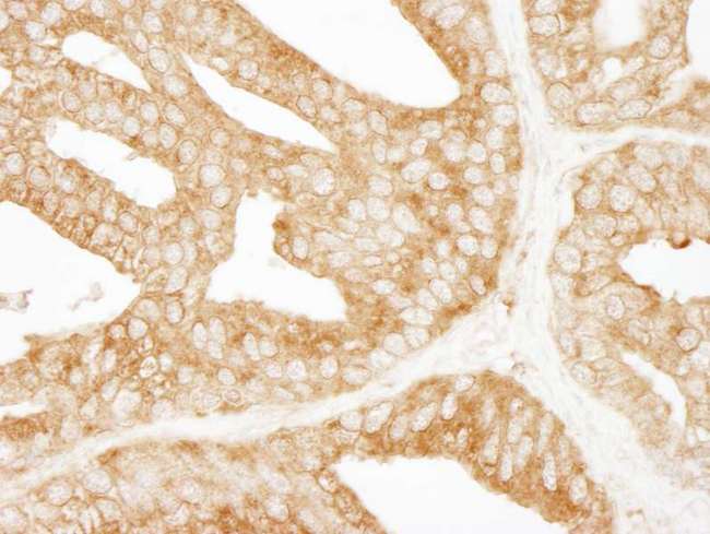 EPS15 Antibody - Detection of Human EPS15 by Immunohistochemistry. Sample: FFPE section of human prostate carcinoma. Antibody: Affinity purified rabbit anti-EPS15 used at a dilution of 1:200 (1 Detection: DAB.