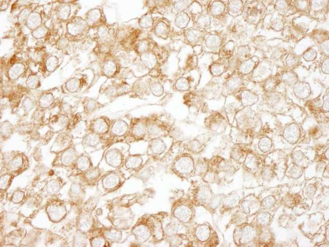 EPS15 Antibody - Detection of Human EPS15 by Immunohistochemistry. Sample: FFPE section of human testicular seminoma. Antibody: Affinity purified rabbit anti-EPS15 used at a dilution of 1:500.