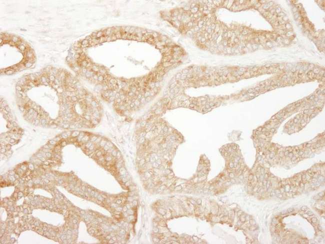 EPS15 Antibody - Detection of Human EPS15 by Immunohistochemistry. Sample: FFPE section of human prostate carcinoma. Antibody: Affinity purified rabbit anti-EPS15 used at a dilution of 1:500.