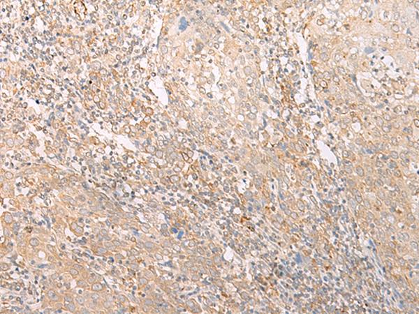 EPS15 Antibody - Immunohistochemistry of paraffin-embedded Human cervical cancer tissue  using EPS15 Polyclonal Antibody at dilution of 1:50(×200)