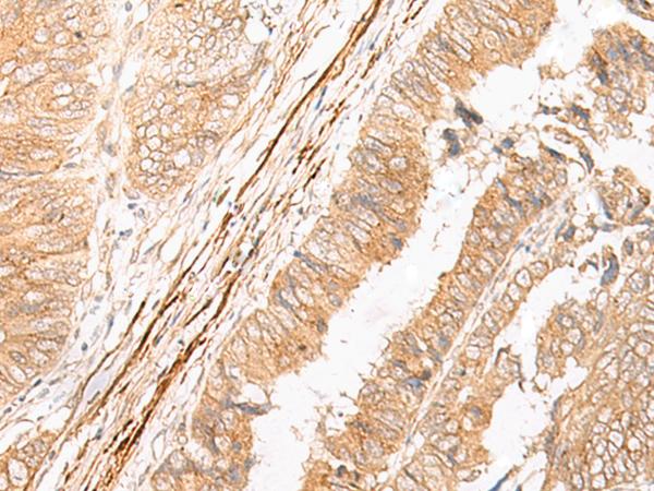 EPS15 Antibody - Immunohistochemistry of paraffin-embedded Human colorectal cancer tissue  using EPS15 Polyclonal Antibody at dilution of 1:50(×200)