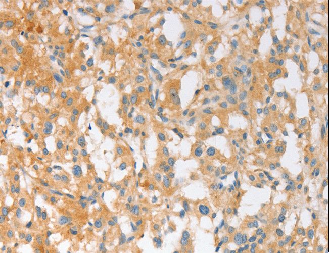 EPS15L1 / EPS15R Antibody - Immunohistochemistry of paraffin-embedded Human thyroid cancer using EPS15L1 Polyclonal Antibody at dilution of 1:30.