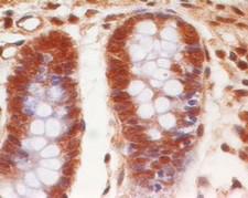 EPS8 Antibody - Immunohistochemistry-Paraffin: EPS8 Antibody (18F1F2) - Formalin-fixed, paraffin-embedded human colon cancer stained with EPS8 antibody (5 ug/ml), peroxidase-conjugate and DAB chromogen.  This image was taken for the unconjugated form of this product. Other forms have not been tested.