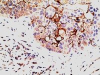 EPS8 Antibody - EPS8 antibody (5 ug/ml) staining of paraffin embedded Human Breast Carcinoma. Steamed antigen retrieval with citrate buffer pH 6, AP-staining.