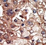 EPS8 Antibody - Formalin-fixed and paraffin-embedded human cancer tissue reacted with the primary antibody, which was peroxidase-conjugated to the secondary antibody, followed by DAB staining. This data demonstrates the use of this antibody for immunohistochemistry; clinical relevance has not been evaluated. BC = breast carcinoma; HC = hepatocarcinoma.