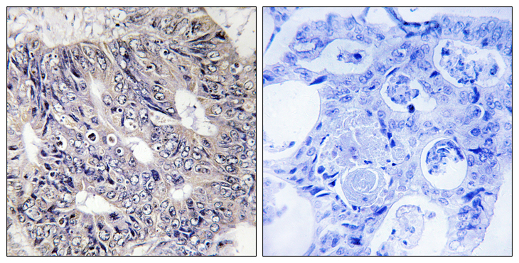 EPS8L1 Antibody - Immunohistochemistry analysis of paraffin-embedded human colon carcinoma tissue, using ES8L1 Antibody. The picture on the right is blocked with the synthesized peptide.