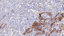 EPS8L1 Antibody - 1:100 staining human urothelial carcinoma tissue by IHC-P. The sample was formaldehyde fixed and a heat mediated antigen retrieval step in citrate buffer was performed. The sample was then blocked and incubated with the antibody for 1.5 hours at 22°C. An HRP conjugated goat anti-rabbit antibody was used as the secondary.