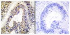 EPS8L1 Antibody - Peptide - + Immunohistochemistry analysis of paraffin-embedded human colon carcinoma tissue using ES8L1 antibody.