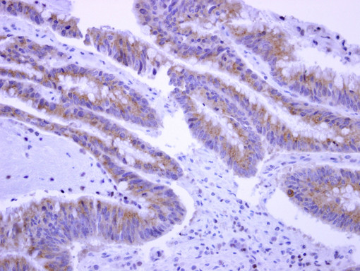 EPS8L2 Antibody - IHC of paraffin-embedded Colon carcinoma, using EPS8L2 antibody at 1:500 dilution.