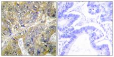 EPS8L3 Antibody - Immunohistochemistry analysis of paraffin-embedded human colon carcinoma tissue, using EPS8L3 Antibody. The picture on the right is blocked with the synthesized peptide.