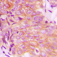 EPS8L3 Antibody - Immunohistochemical analysis of EPS8L3 staining in human breast cancer formalin fixed paraffin embedded tissue section. The section was pre-treated using heat mediated antigen retrieval with sodium citrate buffer (pH 6.0). The section was then incubated with the antibody at room temperature and detected using an HRP conjugated compact polymer system. DAB was used as the chromogen. The section was then counterstained with hematoxylin and mounted with DPX.
