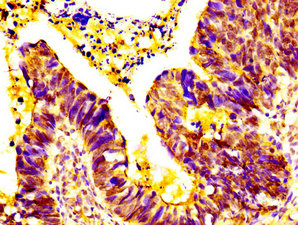 EPS8L3 Antibody - Immunohistochemistry image at a dilution of 1:500 and staining in paraffin-embedded human ovarian cancer performed on a Leica BondTM system. After dewaxing and hydration, antigen retrieval was mediated by high pressure in a citrate buffer (pH 6.0) . Section was blocked with 10% normal goat serum 30min at RT. Then primary antibody (1% BSA) was incubated at 4 °C overnight. The primary is detected by a biotinylated secondary antibody and visualized using an HRP conjugated SP system.