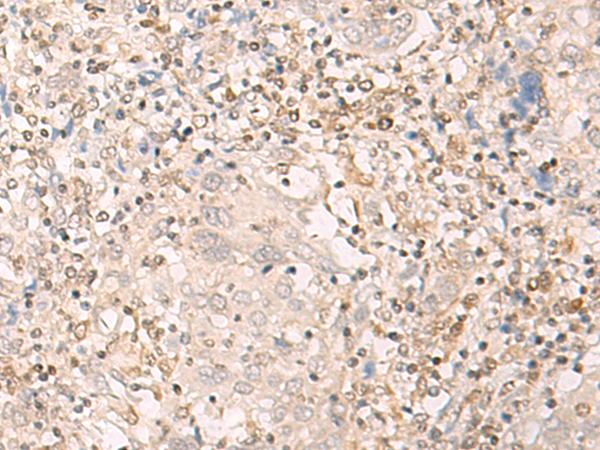 EPSTI1 Antibody - Immunohistochemistry of paraffin-embedded Human cervical cancer tissue  using EPSTI1 Polyclonal Antibody at dilution of 1:25(×200)