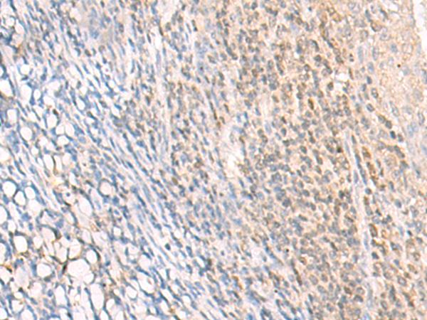 EPSTI1 Antibody - Immunohistochemistry of paraffin-embedded Human tonsil tissue  using EPSTI1 Polyclonal Antibody at dilution of 1:25(×200)