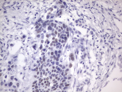 ER Alpha / Estrogen Receptor Antibody - IHC of paraffin-embedded Carcinoma of Human kidney tissue using anti-ESR1 mouse monoclonal antibody. (Heat-induced epitope retrieval by 1 mM EDTA in 10mM Tris, pH8.5, 120°C for 3min).