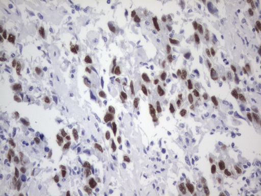 ER Alpha / Estrogen Receptor Antibody - IHC of paraffin-embedded Adenocarcinoma of Human ovary tissue using anti-ESR1 mouse monoclonal antibody. (Heat-induced epitope retrieval by 1 mM EDTA in 10mM Tris, pH8.5, 120°C for 3min).