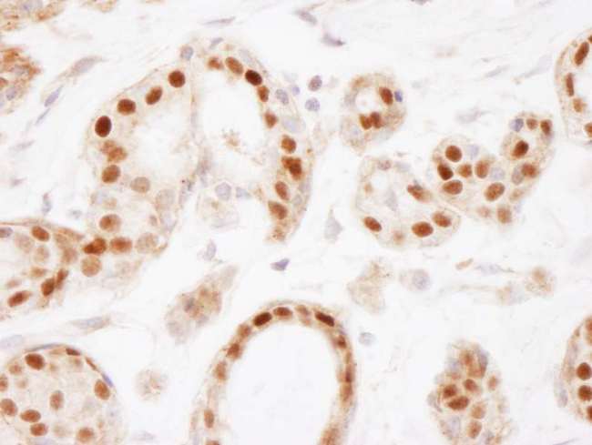 ER Alpha / Estrogen Receptor Antibody - Detection of Human Estrogen Receptor Alpha by Immunohistochemistry. Sample: FFPE section of human breast. Antibody: Affinity purified rabbit anti-Estrogen Receptor Alpha used at a dilution of 1:2,500 (0.4 Detection: DAB.