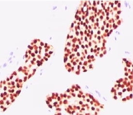 ER Alpha / Estrogen Receptor Antibody - IHC testing of human breast carcinoma stained with Estrogen receptor antibody (NR3Ga-3).  This image was taken for the unmodified form of this product. Other forms have not been tested.