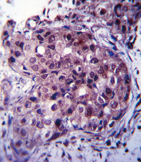 ER Alpha / Estrogen Receptor Antibody - ESR1/ER Antibody immunohistochemistry of formalin-fixed and paraffin-embedded human breast carcinoma followed by peroxidase-conjugated secondary antibody and DAB staining.